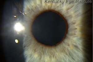 Close up of eye while restoring corneal clarity