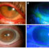 4 eyes showing a need for early intervention with cryopreserved amniotic membrane