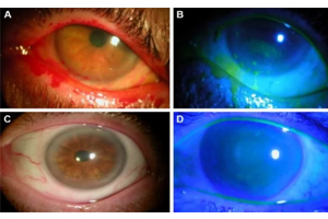 4 eyes showing a need for early intervention with cryopreserved amniotic membrane