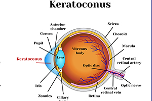 Keratoconus - A Protocol for Use of PROKERA after Corneal Collagen Cross-Linking